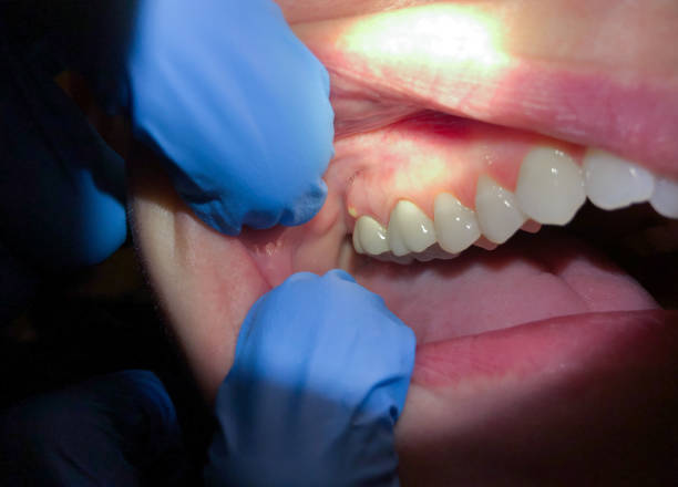 Best Emergency Dental Care for Abscessed Tooth in Maud, TX